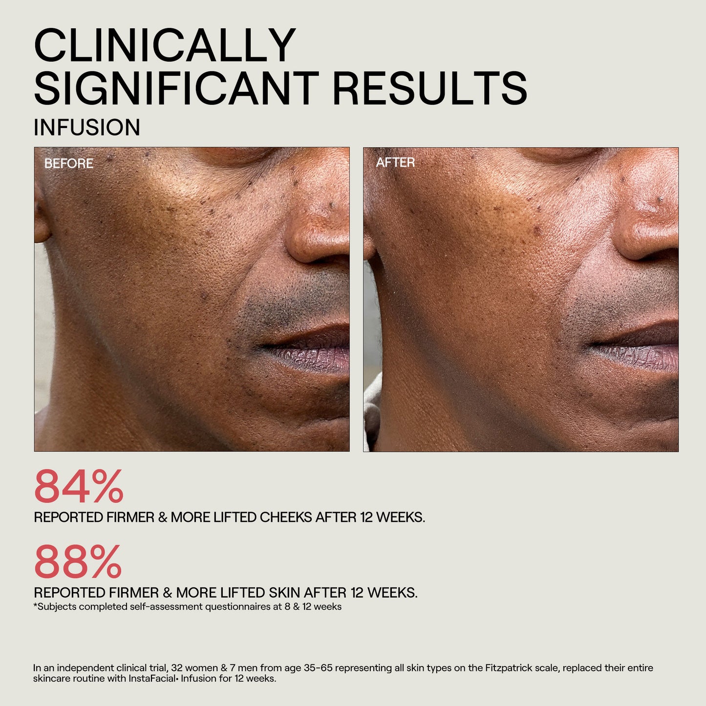 Before and after comparison of facial skin with text about clinically significant results from an infusion treatment.