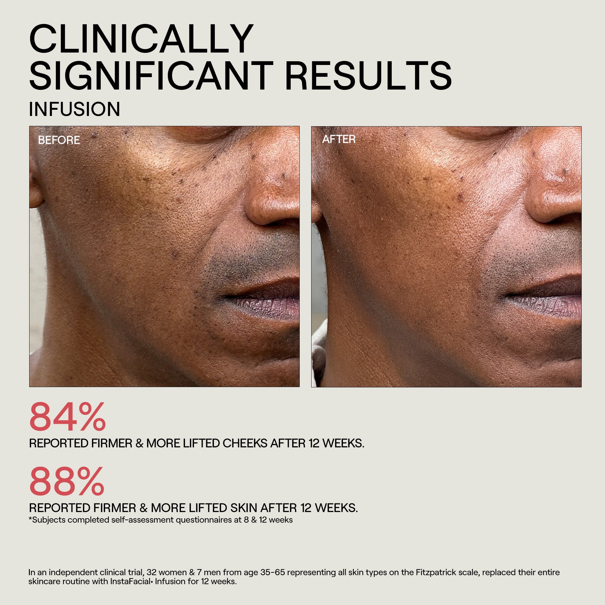 InstaFacial® Infusion | Biomimetic Microcollagen Matrix – Dr