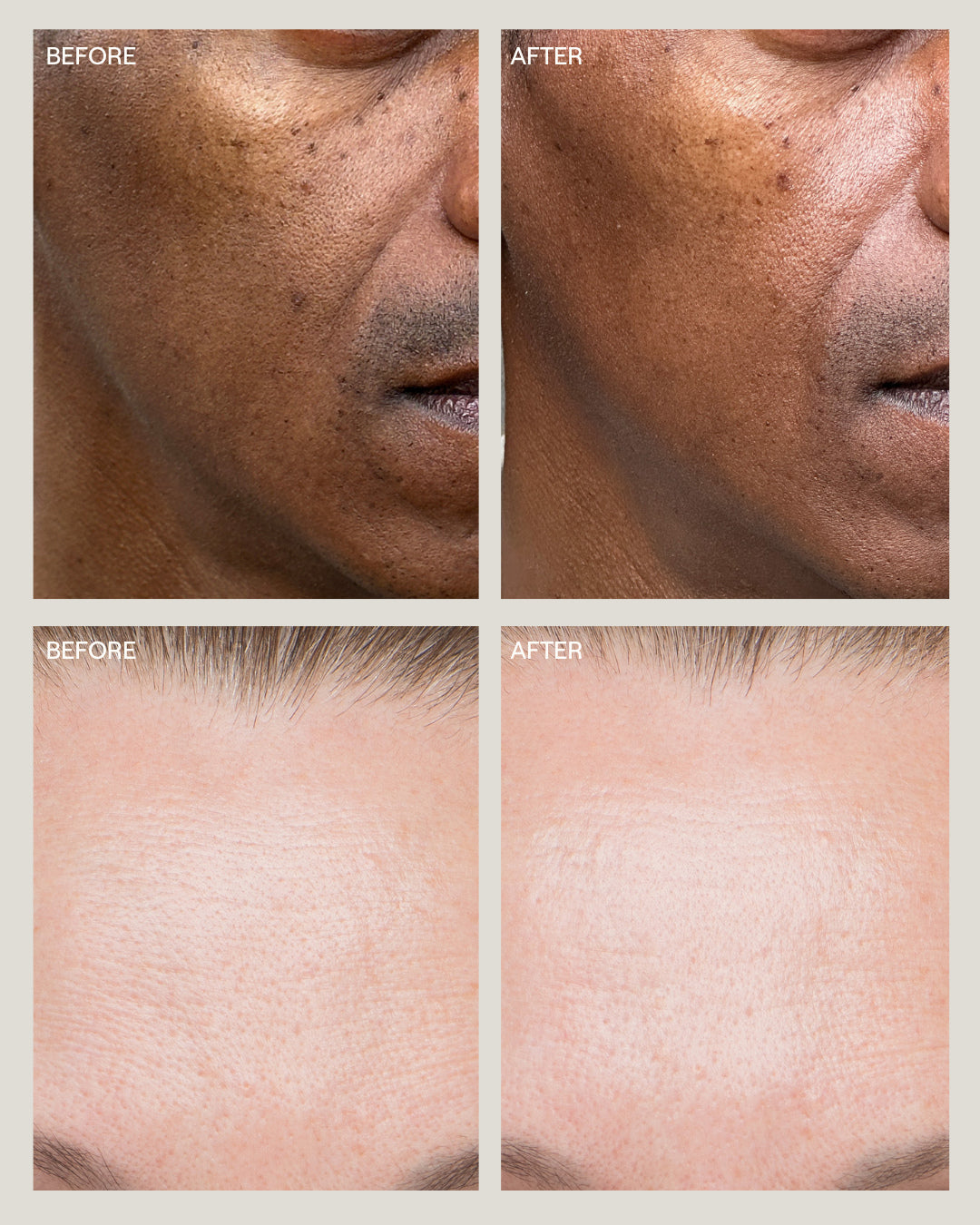 InstaFacial® Infusion | Biomimetic Microcollagen Matrix – Dr
